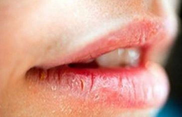 Da li su vam usta stalno suha? To može biti signal ove OZBILJNE bolesti!