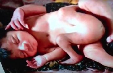 Ovo (ne) želite da vidite! Rođena beba s 4 noge i 2 p*nisa! (VIDEO)