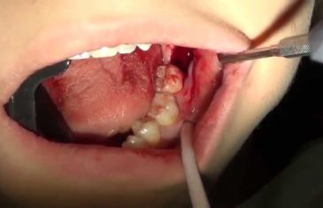 Vrlo jednostavno i efikasno: Kako ukloniti kamenac sa zuba bez odlaska kod zubara!