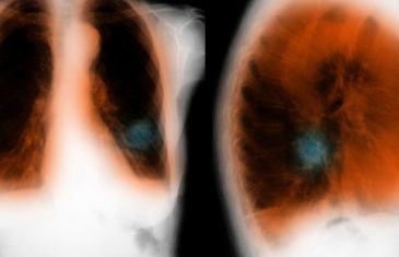 Zagađen zrak je okidač za hroničnu opstruktivnu bolest pluća: Evo zašto baš u ovo vrijeme treba da se čuvate